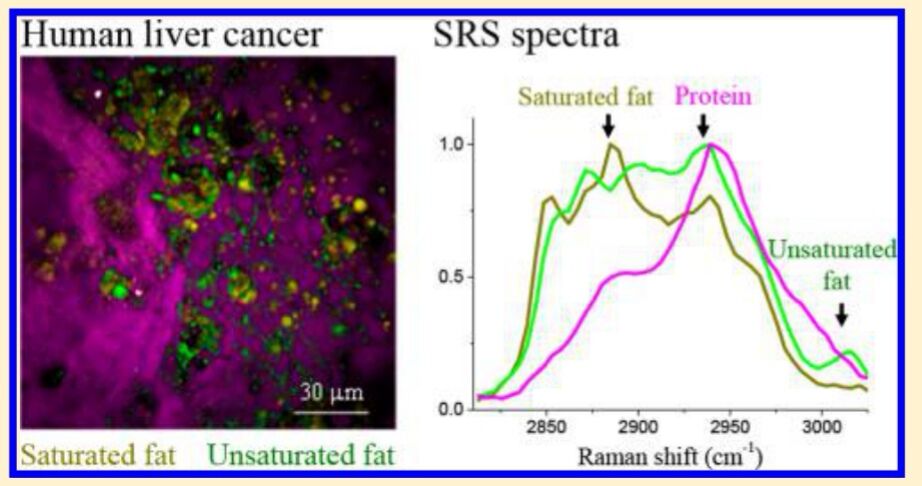 超光谱受激拉曼散射显微镜揭示了肝癌组织中饱和脂肪的异常积累